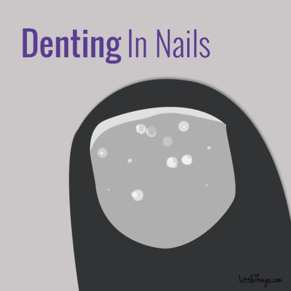 Denting In Nails