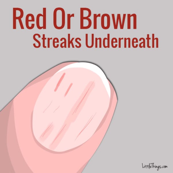 Red Or Brown Streaks Underneath Nails