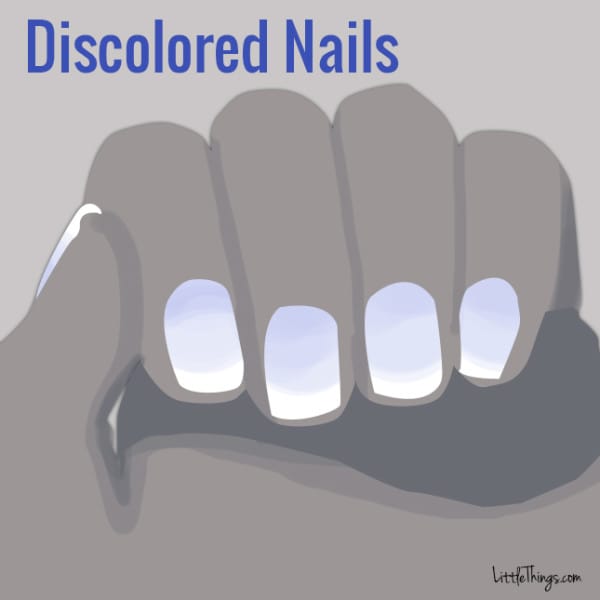 Discolored Nails