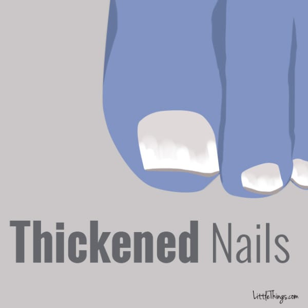 Thickened Nails