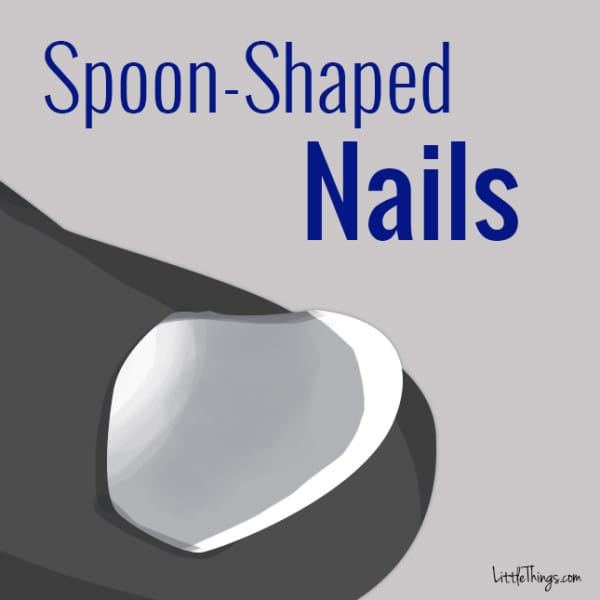 Spoon-Shaped Nails