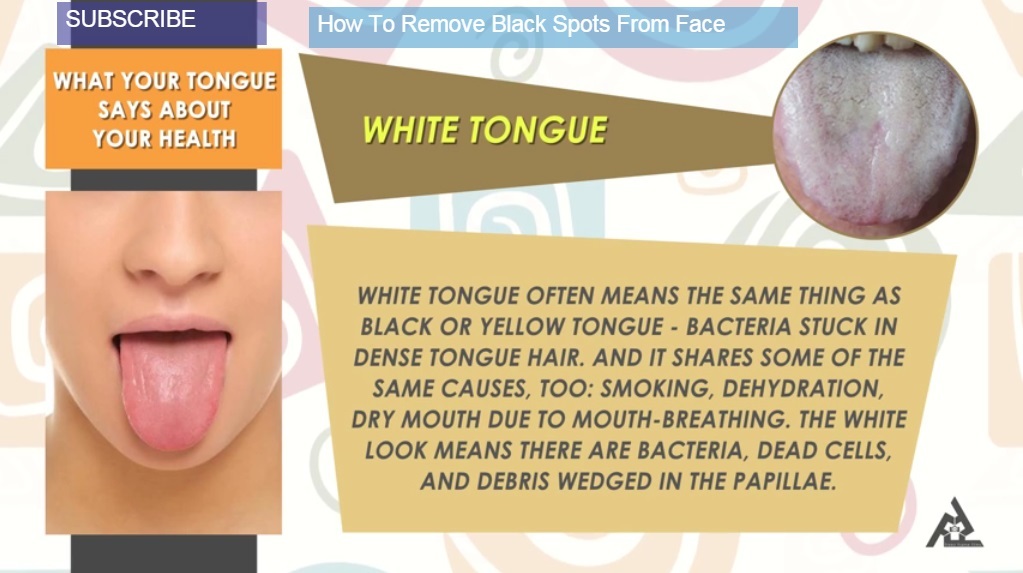White Tongue: 